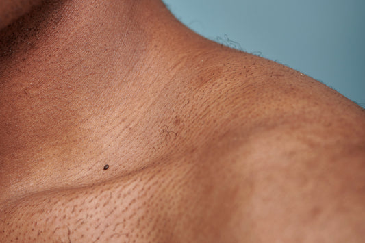 Hyperpigmentation Treatments For Men