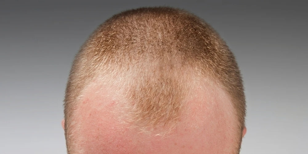 how to stop thinning hair